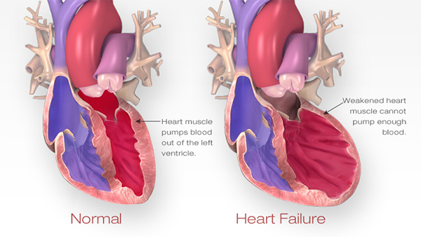 Burial Insurance With Congestive Heart Failure