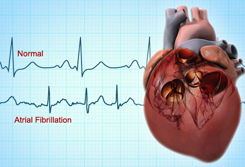 Burial Insurance With Atrial Fibrillation