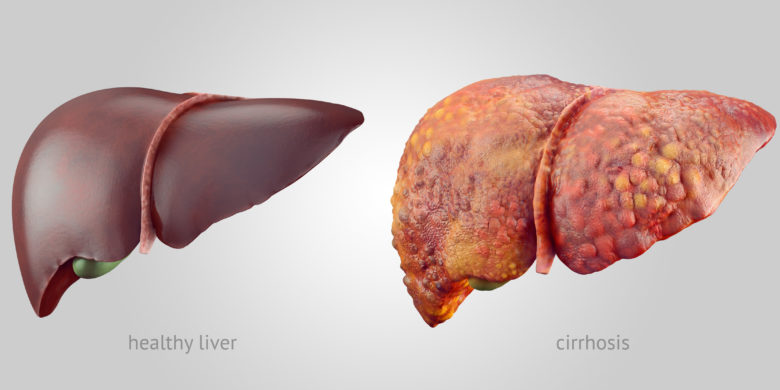 Burial Insurance With Cirrhosis